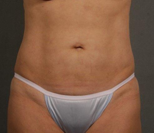 Liposuction after at Preminger Plastic Surgery in New York, NY