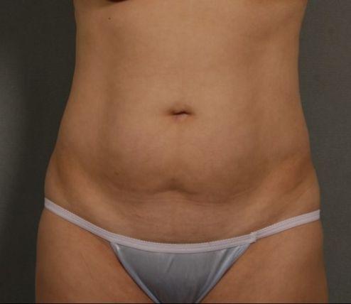 Liposuction before at Preminger Plastic Surgery in New York, NY