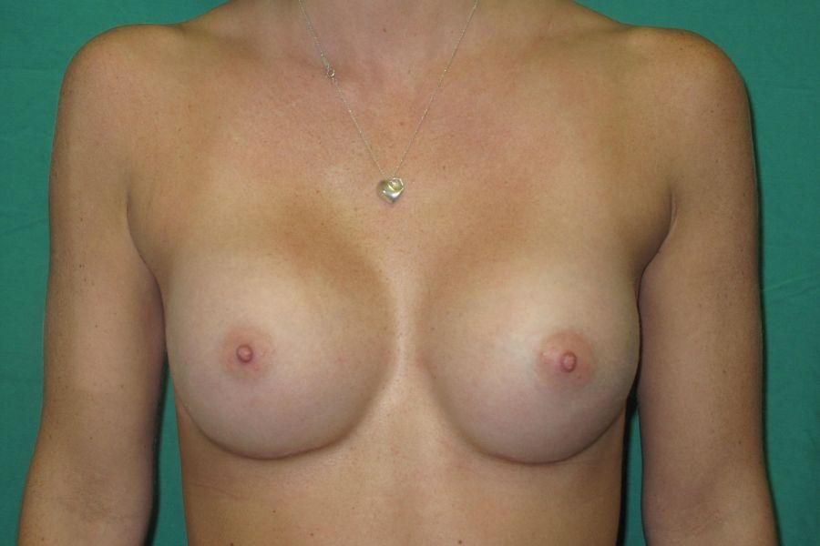 Preminger Plastic Surgery breast augmentation after — New York, NY