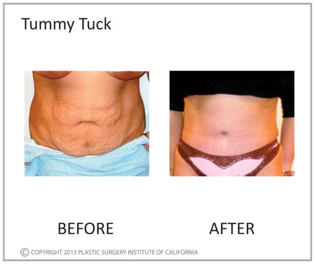 Mommy Makeover result at Plastic Surgery Institute of California in Huntington Beach, CA