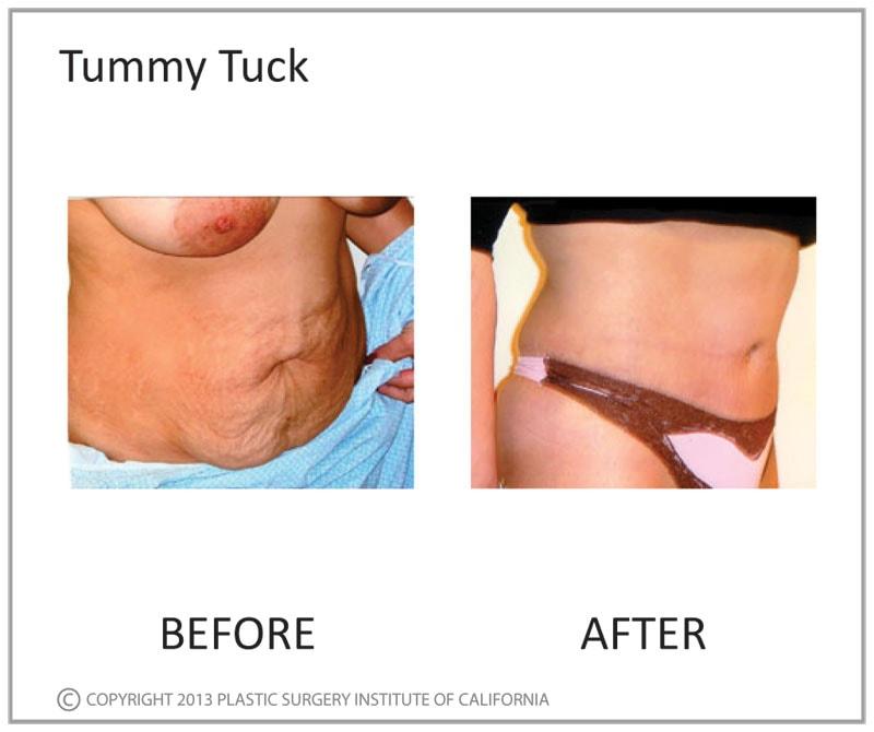Plastic Surgery Institute of California tummy tuck result — Huntington Beach, CA