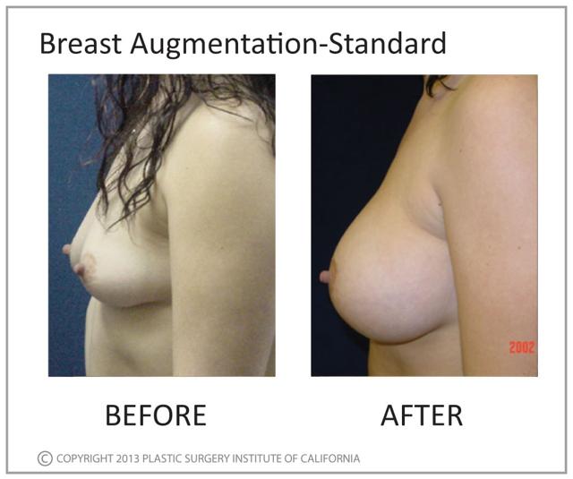 Breast Augmentation result at Plastic Surgery Institute of California in Huntington Beach, CA