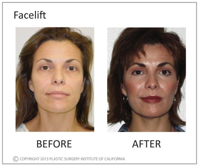 Deep Plane Facelift result at Plastic Surgery Institute of California in Huntington Beach, CA