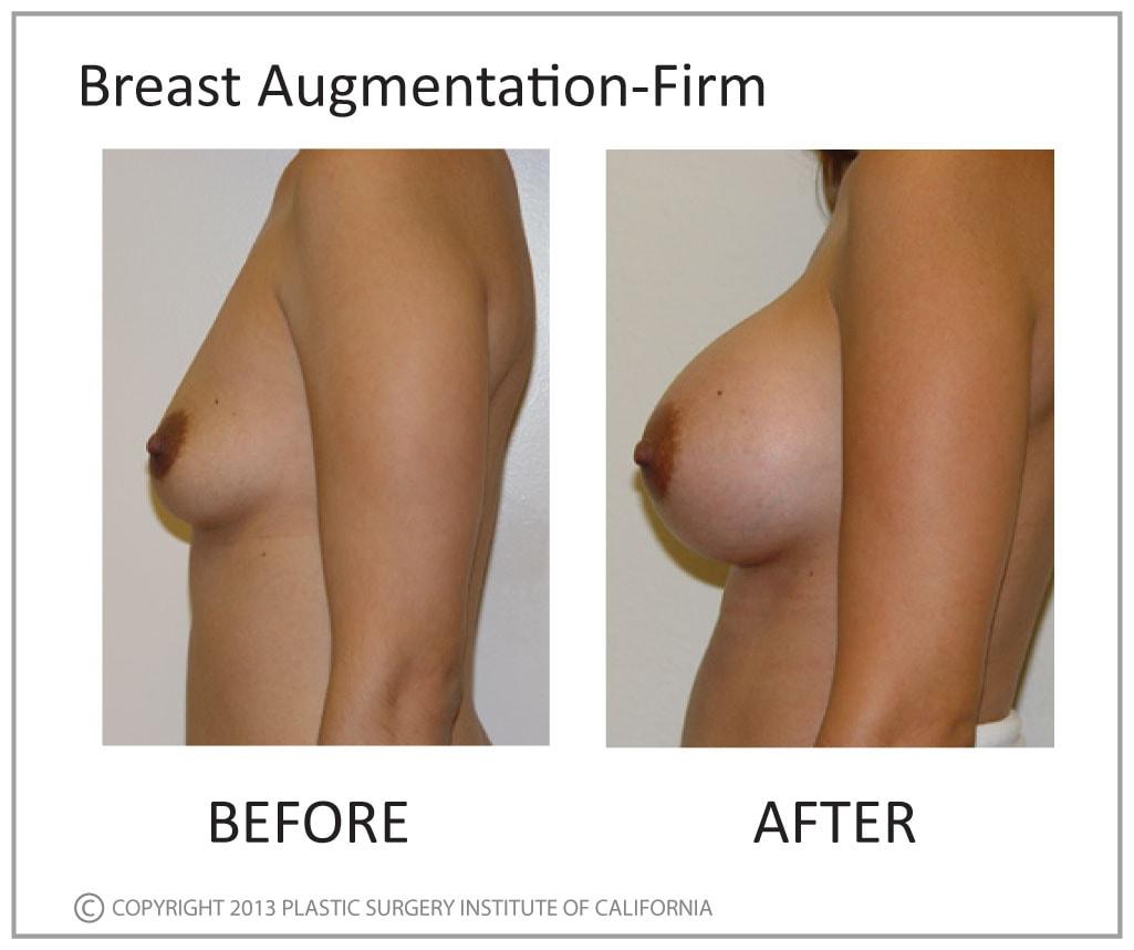 Plastic Surgery Institute of California breast augmentation result — Huntington Beach, CA