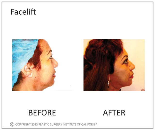 Deep Plane Facelift result at Plastic Surgery Institute of California in Huntington Beach, CA