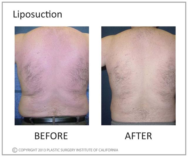 Liposuction result at Plastic Surgery Institute of California in Huntington Beach, CA