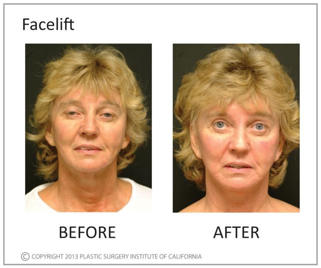 Deep Plane Facelift result at Plastic Surgery Institute of California in Huntington Beach, CA