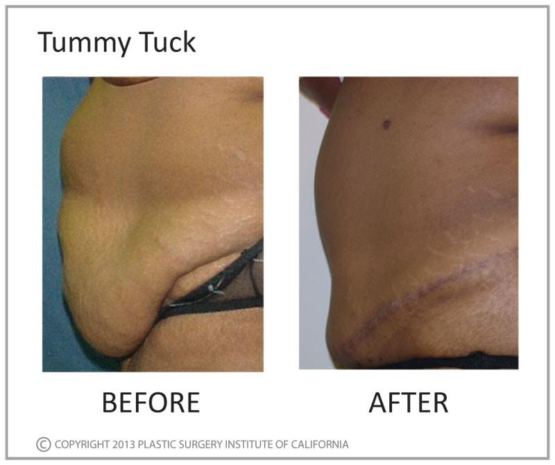 Plastic Surgery Institute of California tummy tuck result — Huntington Beach, CA
