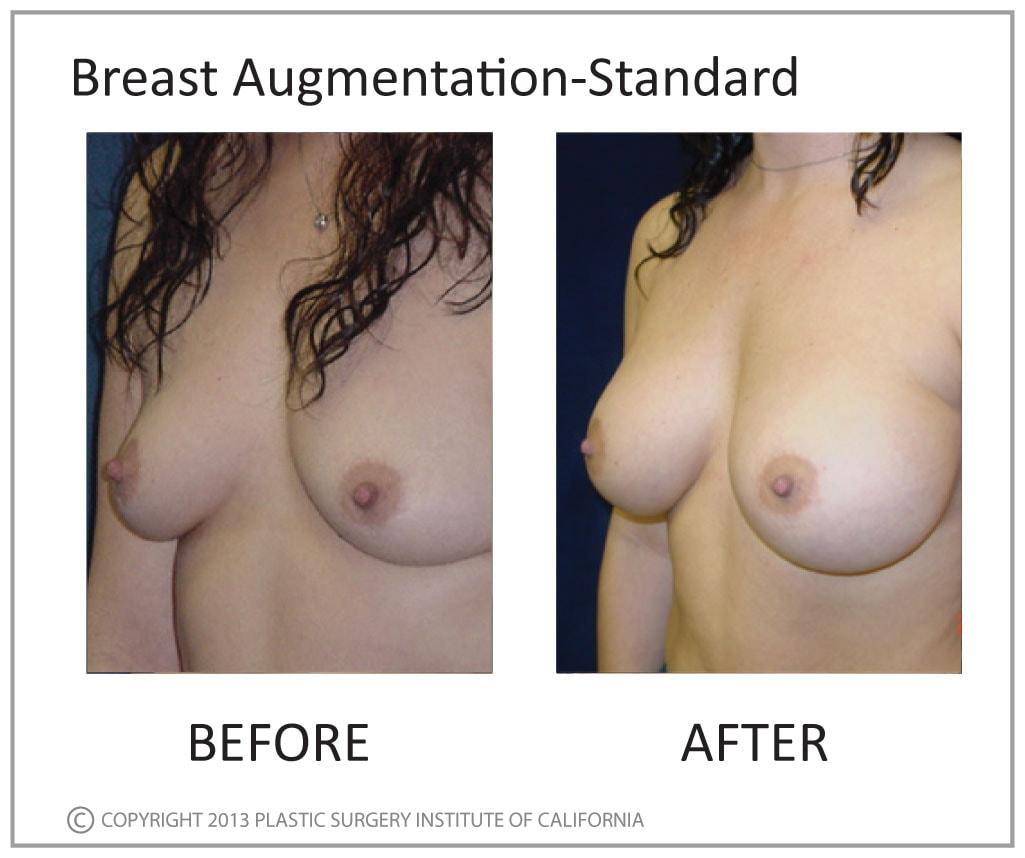 Plastic Surgery Institute of California breast augmentation result — Huntington Beach, CA