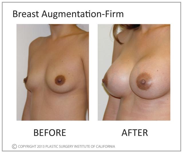Breast Augmentation result at Plastic Surgery Institute of California in Huntington Beach, CA