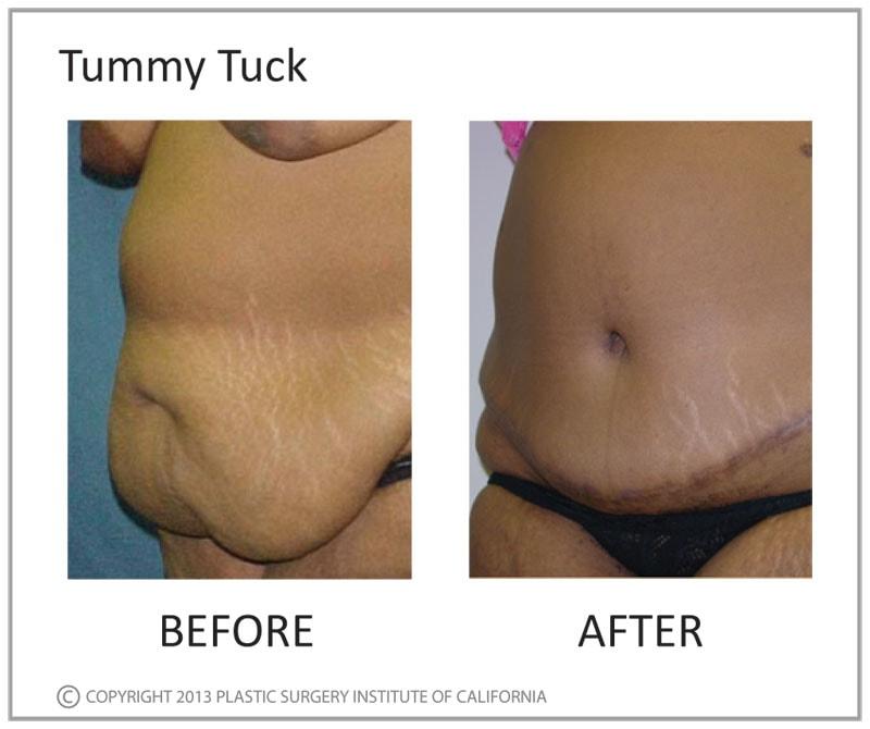 Plastic Surgery Institute of California tummy tuck result — Huntington Beach, CA