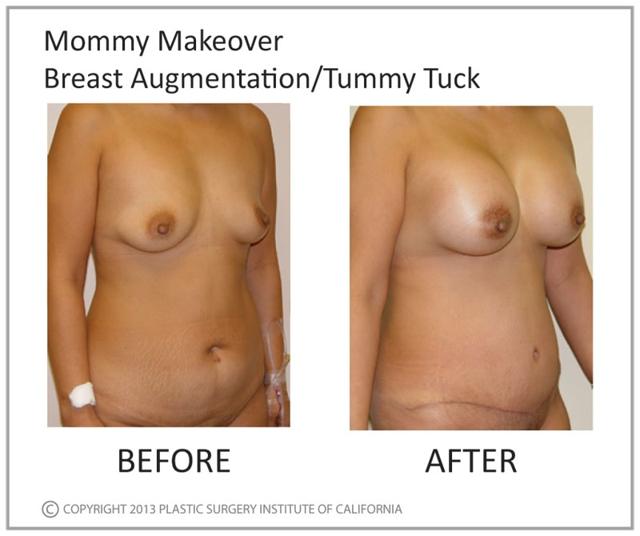 Mommy Makeover result at Plastic Surgery Institute of California in Huntington Beach, CA