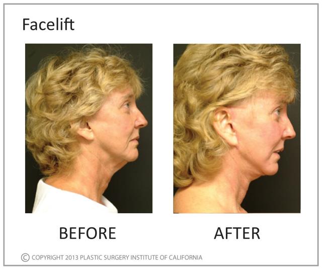 Deep Plane Facelift result at Plastic Surgery Institute of California in Huntington Beach, CA