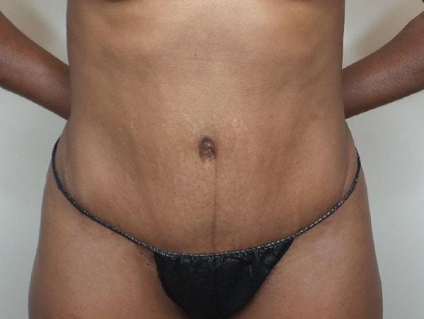 Ciaravino Total Beauty tummy tuck after — Houston, TX