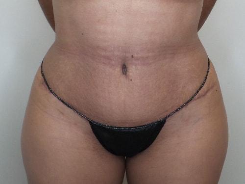 Ciaravino Total Beauty tummy tuck after — Houston, TX