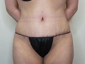 Ciaravino Total Beauty tummy tuck after — Houston, TX
