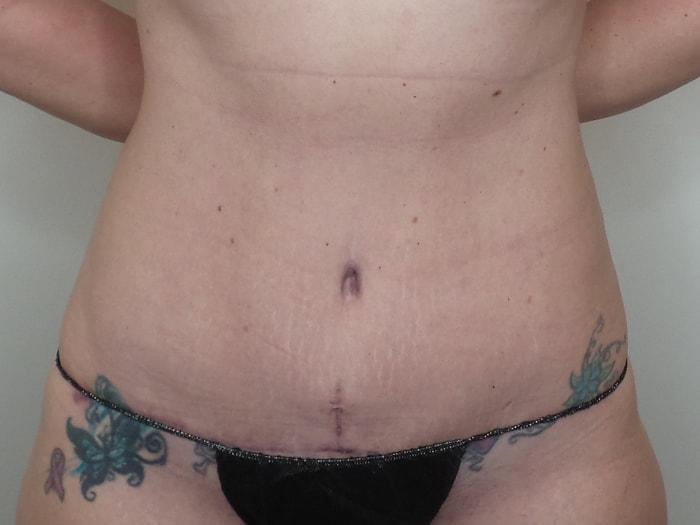 Ciaravino Total Beauty tummy tuck after — Houston, TX