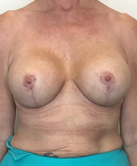 Ciaravino Total Beauty breast augmentation revision after — Houston, TX