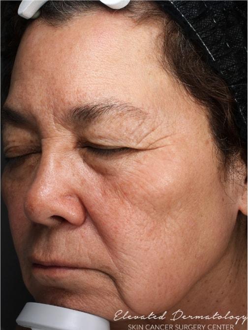 Elevated Dermatology laser treatment after — Parker, CO