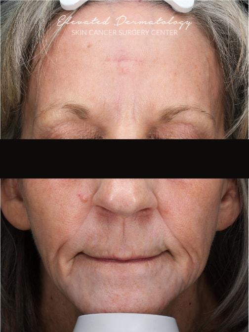 Elevated Dermatology laser treatment after — Parker, CO