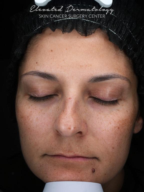 Morpheus8 before at Elevated Dermatology in Parker, CO