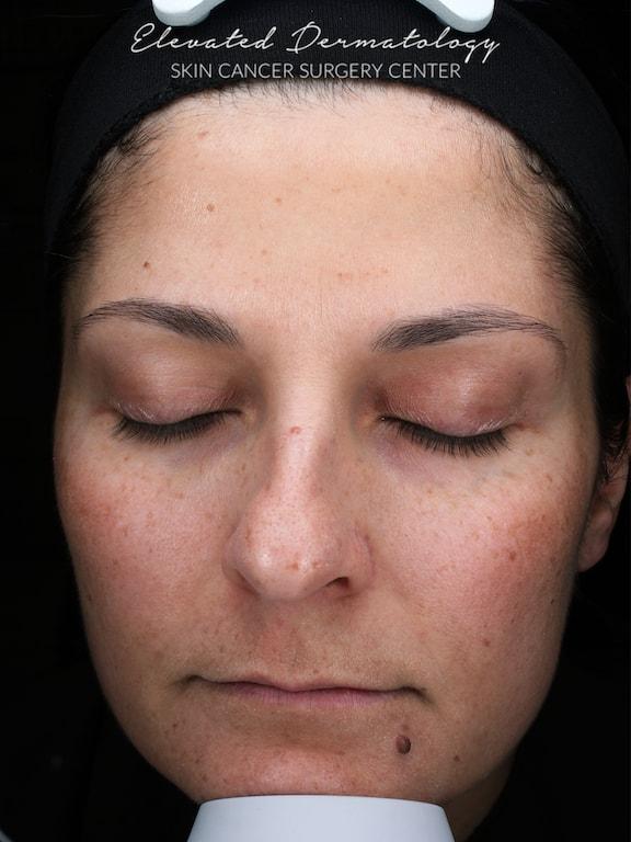 Morpheus8 after at Elevated Dermatology in Parker, CO