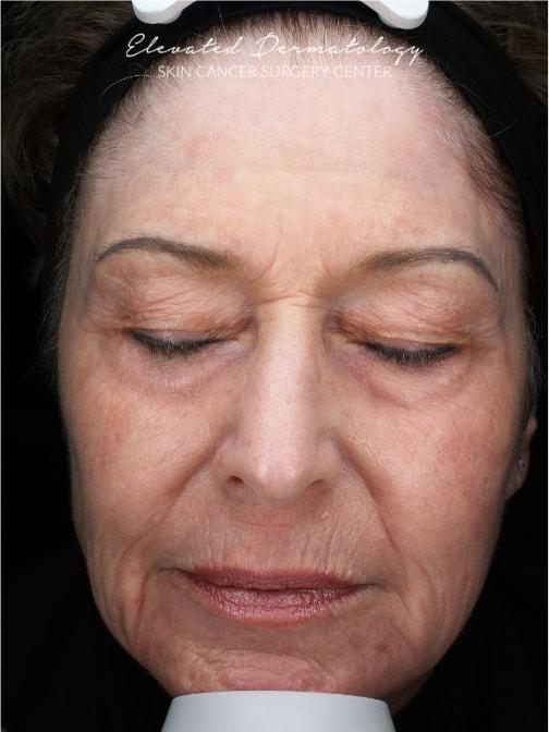Elevated Dermatology laser treatment after — Parker, CO