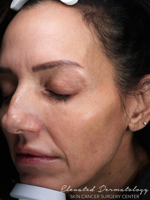 Elevated Dermatology laser treatment after — Parker, CO
