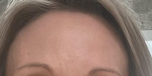 Botox after at Jewell Aesthetics in Dallas, TX