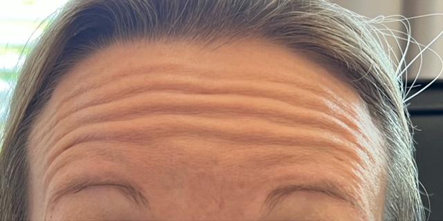 Botox before at Jewell Aesthetics in Dallas, TX