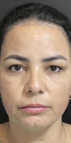 Jewell Aesthetics after — Dallas, TX