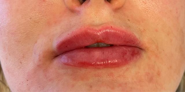 Jewell Aesthetics breast augmentation after — Dallas, TX