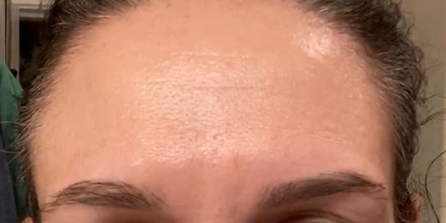 Botox after at Jewell Aesthetics in Dallas, TX