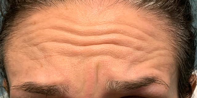 Botox before at Jewell Aesthetics in Dallas, TX