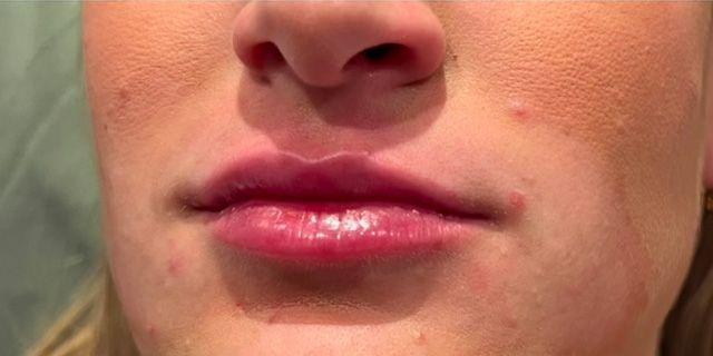 Jewell Aesthetics lip filler after — Dallas, TX