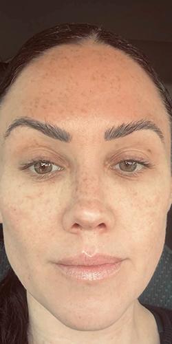 Jewell Aesthetics after — Dallas, TX