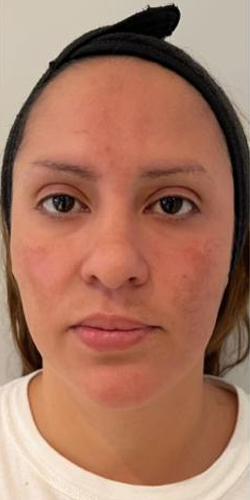 Lip Filler before at Jewell Aesthetics in Dallas, TX