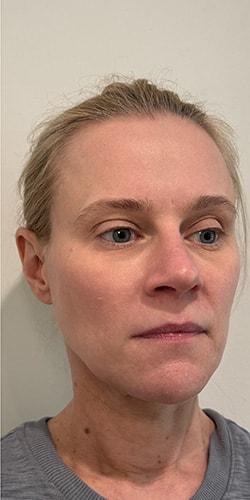 Juvederm before at Jewell Aesthetics in Dallas, TX