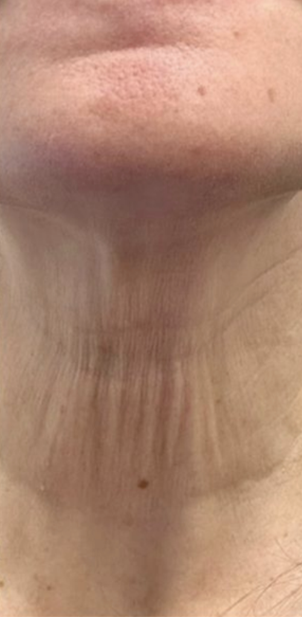 Jewell Aesthetics microneedling after — Dallas, TX
