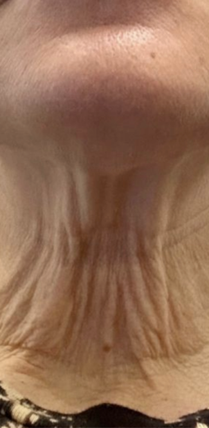Chemical Peel before at Jewell Aesthetics in Dallas, TX