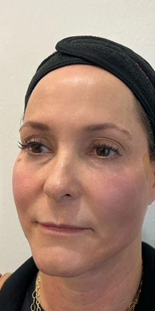 Dermal Fillers after at Jewell Aesthetics in Dallas, TX