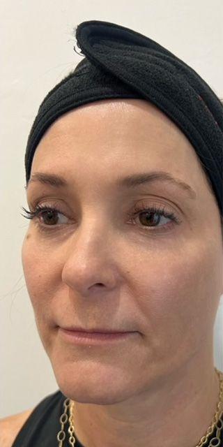 Dermal Fillers before at Jewell Aesthetics in Dallas, TX