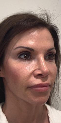 Dermal Fillers after at Jewell Aesthetics in Dallas, TX