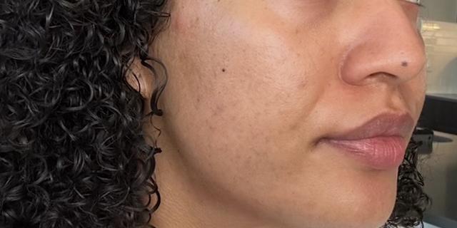 Microneedling after at Jewell Aesthetics in Dallas, TX