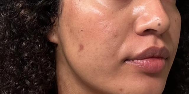 Microneedling before at Jewell Aesthetics in Dallas, TX