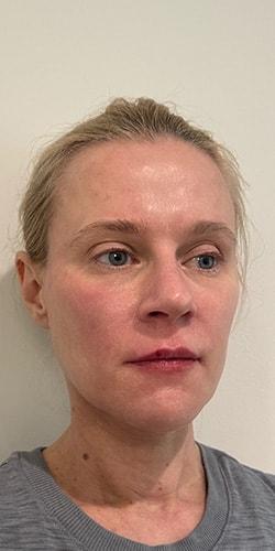 Juvederm after at Jewell Aesthetics in Dallas, TX