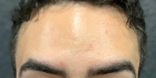 Botox after at Jewell Aesthetics in Dallas, TX