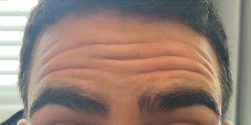 Botox before at Jewell Aesthetics in Dallas, TX