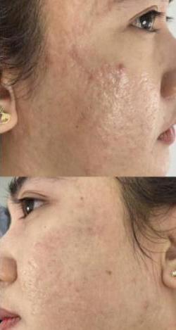 Jewell Aesthetics microneedling after — Dallas, TX