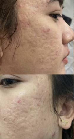 Microneedling before at Jewell Aesthetics in Dallas, TX